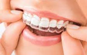 Aparelhos Dentários (Invisalign)