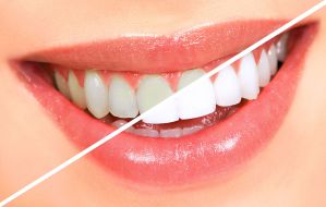 Implantes Dentários