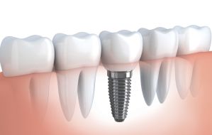 Implantes Dentários