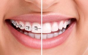 Implantes Dentários